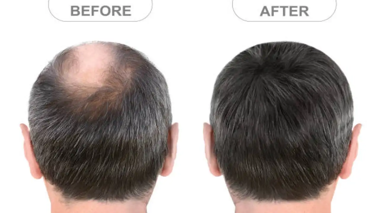 "Vitamine D" plays an important for hair growth "Vitamine D" plays an important for hair growth